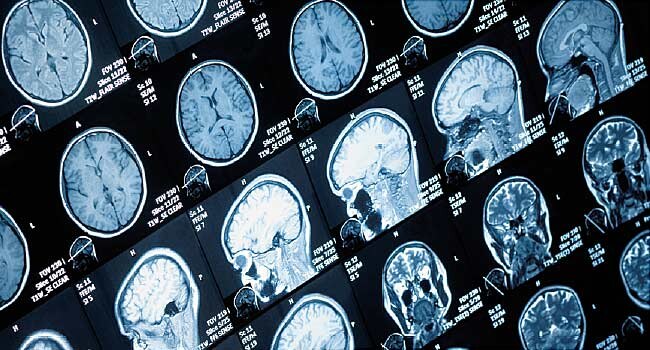 Firms Race to Find New Ways to Scan Brain Health - WebMD